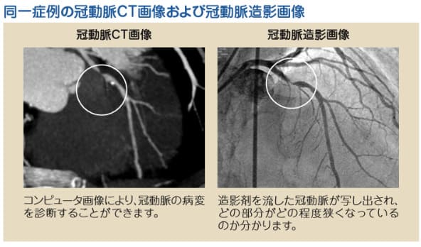 同一症例の冠動脈CT画像および冠動脈造影画像